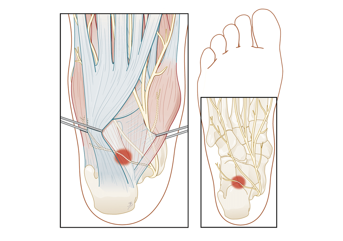 Een operatie bij zenuwbeknelling in de hiel wordt pas overwogen bij aanhoudende hielpijn en onvoldoende effect van andere behandelingen.. Een operatie bij zenuwbeknelling in de hiel wordt pas overwogen bij aanhoudende hielpijn en onvoldoende effect van andere behandelingen.